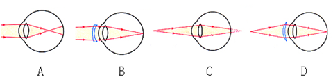 下列图形中的"眼睛"及矫正,与矫正远视眼相符的是 ( )
