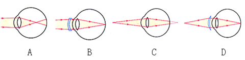 下列图形中的"眼睛"及矫正,与矫正远视眼相符的是)